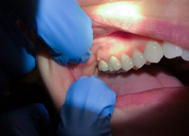 Best Emergency Dental Care for Abscessed Tooth in Harmony, PA
